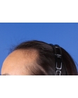 Before Hair Transplant&nbsp;Hairline